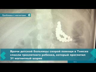 in tomsk, doctors saved a teen who swallowed magnetic balls